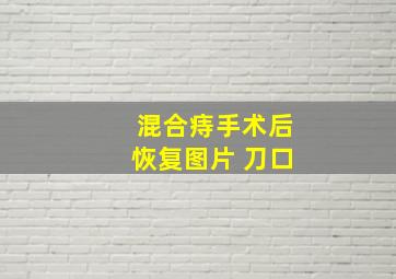 混合痔手术后恢复图片 刀口